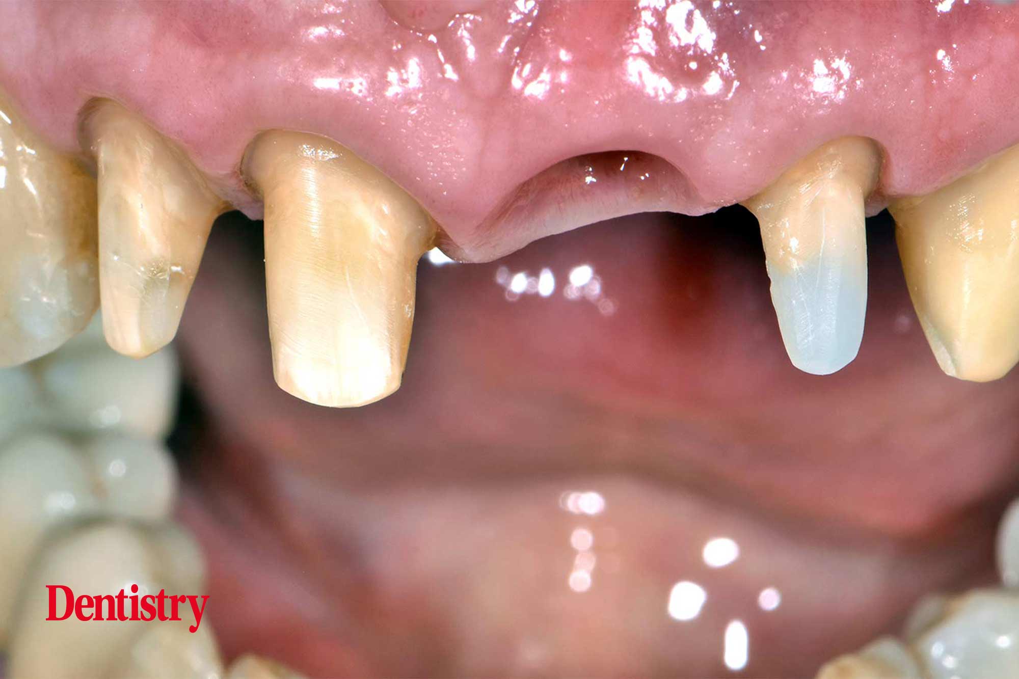 cementation
