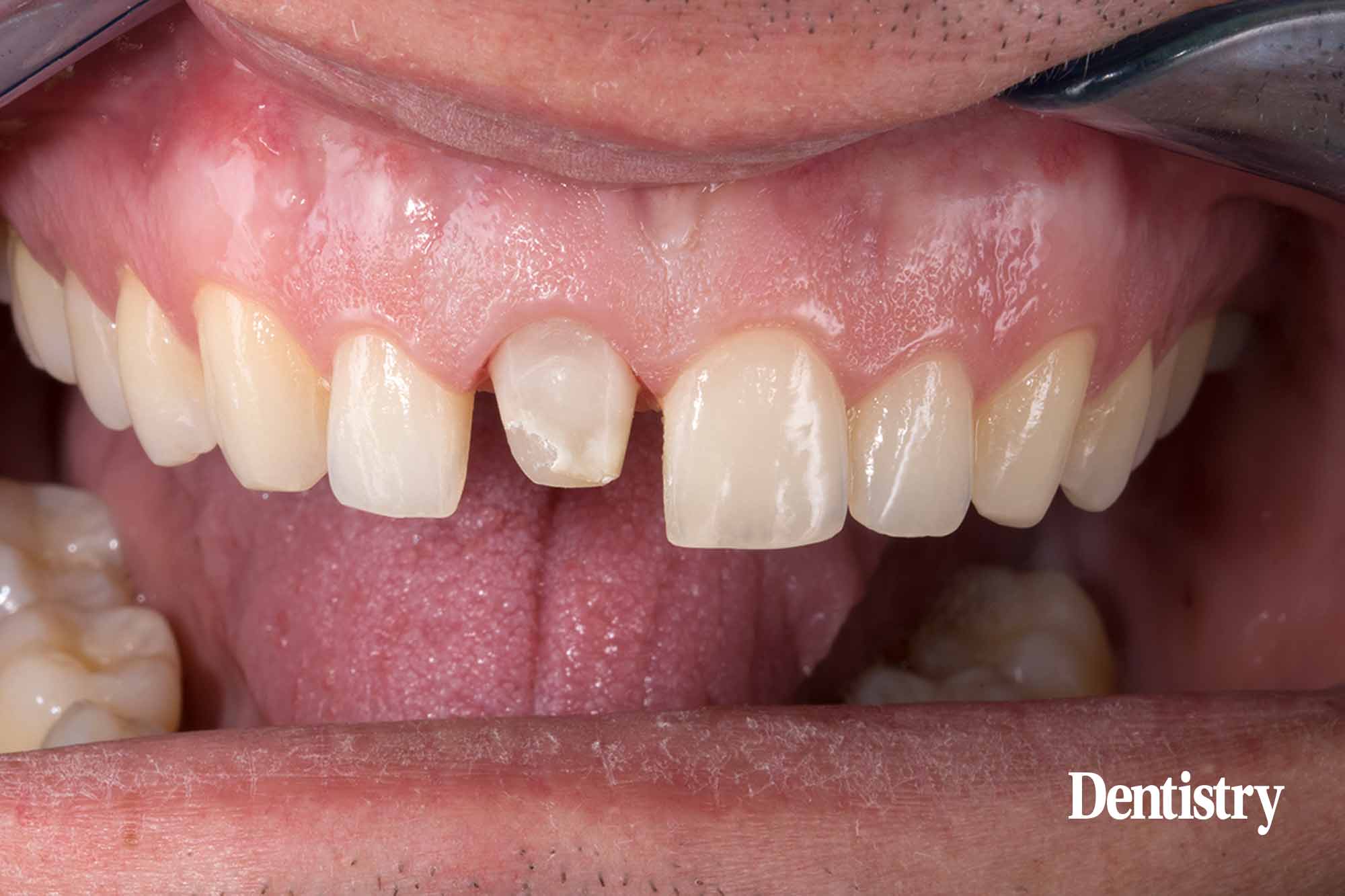 tooth shade determination