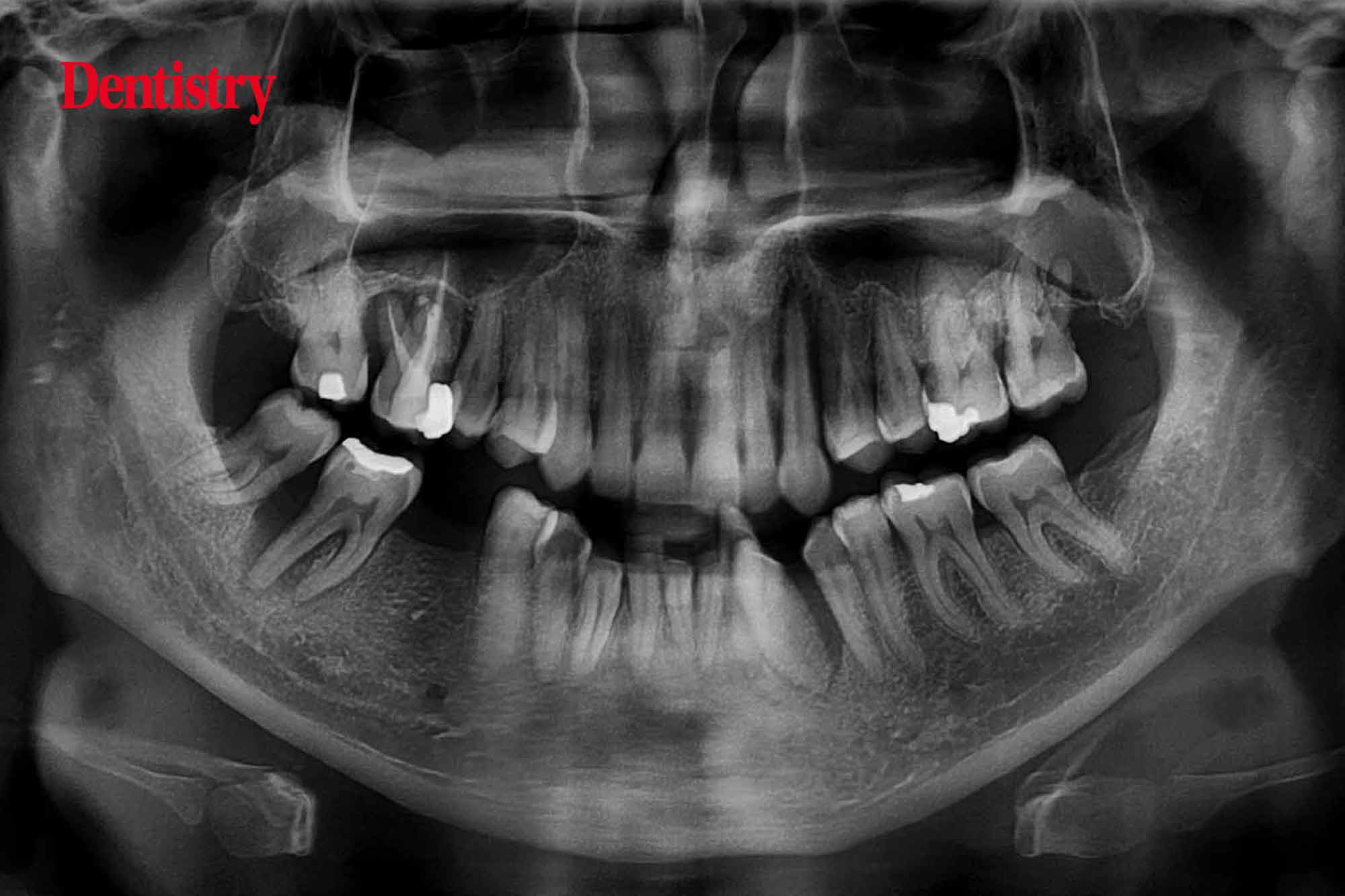 pivot root syndrome