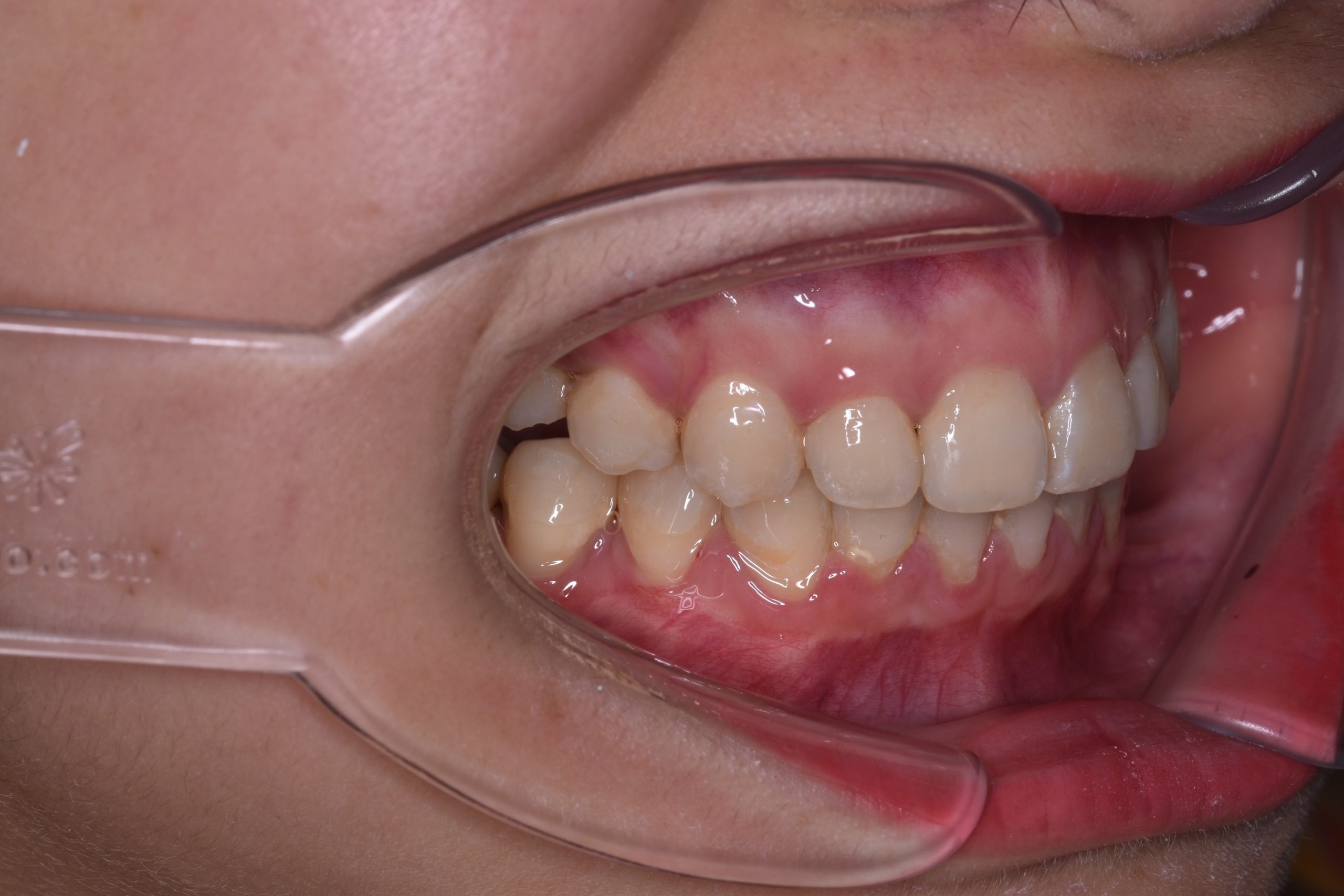 Post Treatment Buccal