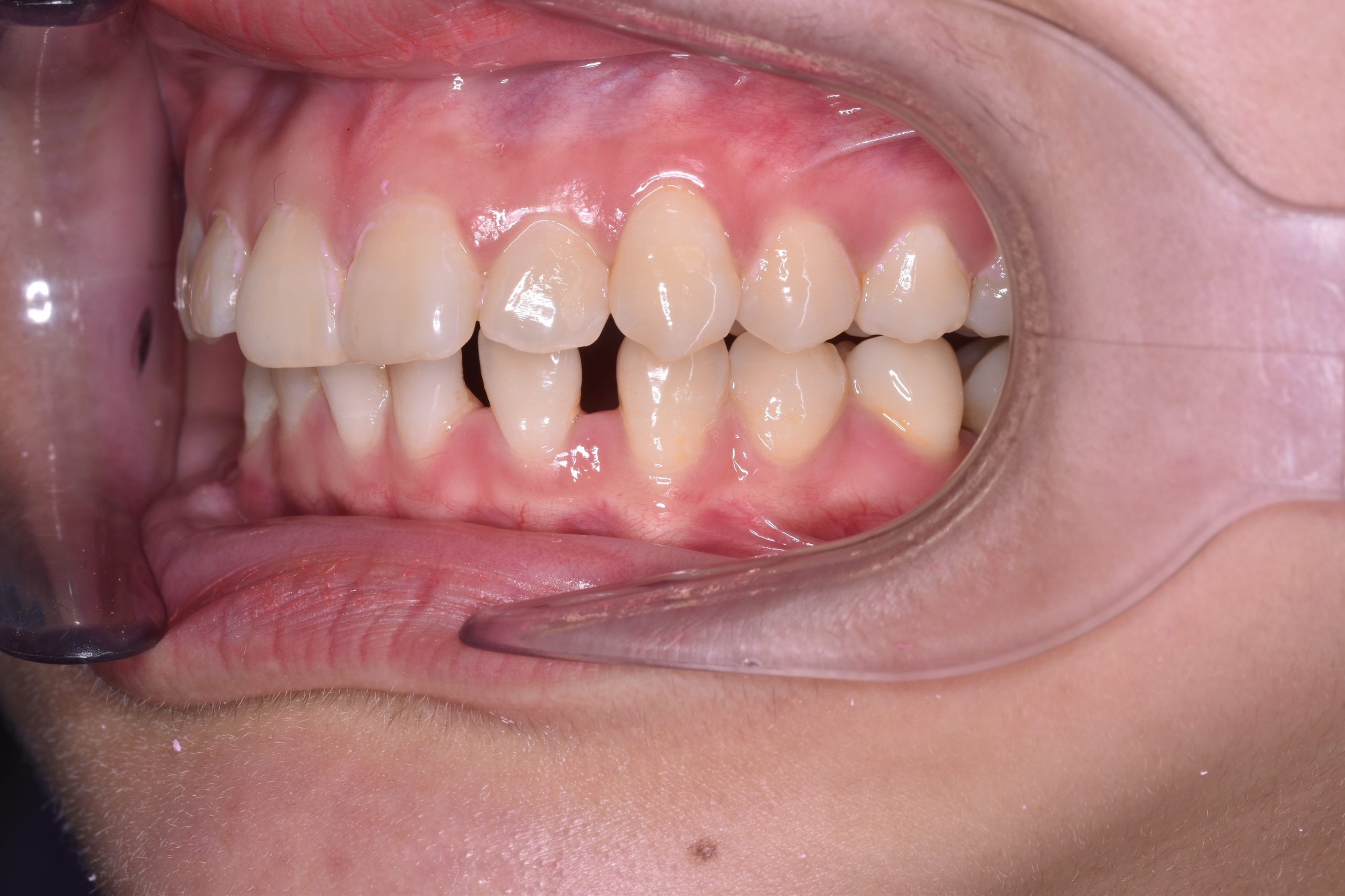 Pre Treatment Buccal