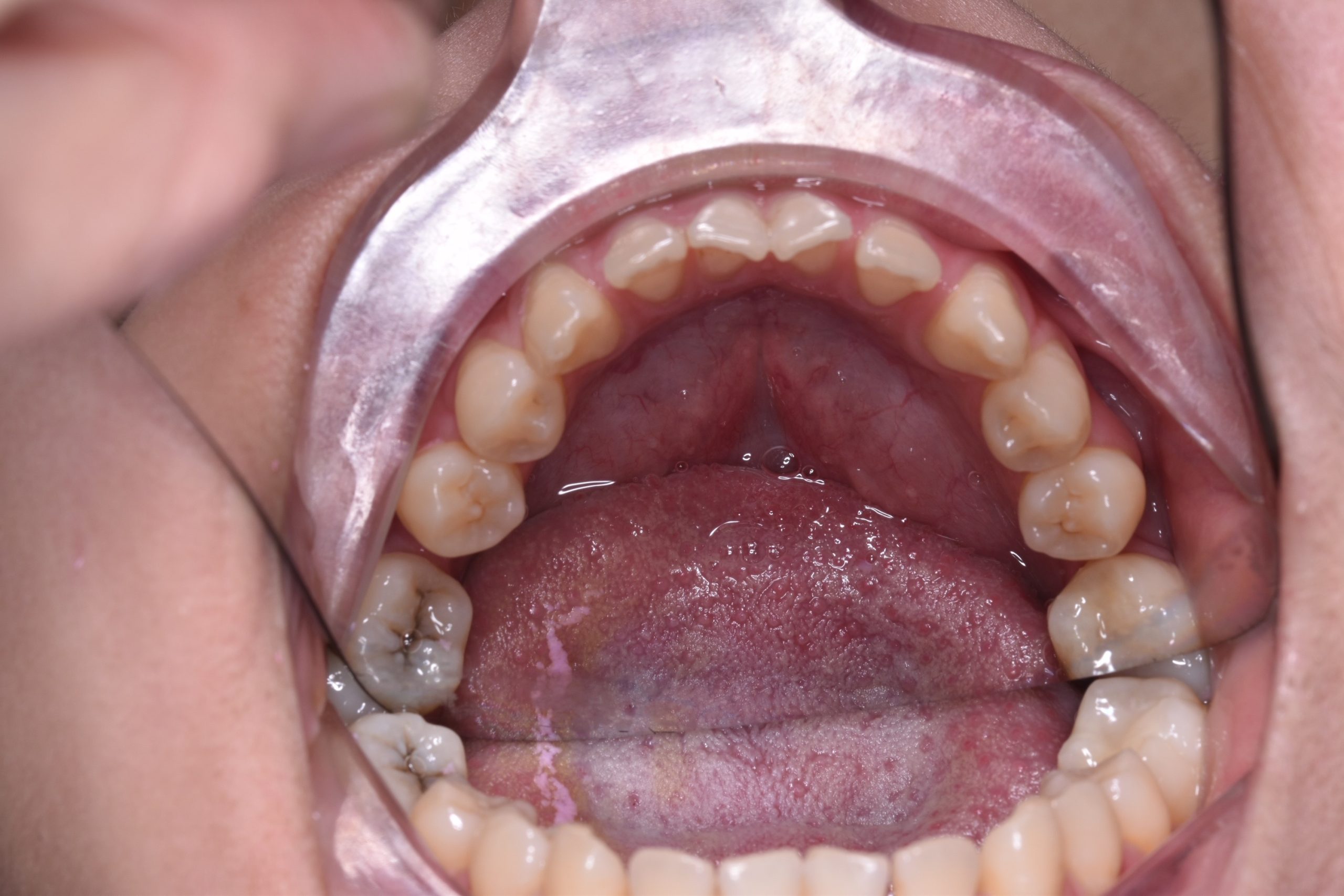 Pre treatment occlusal view