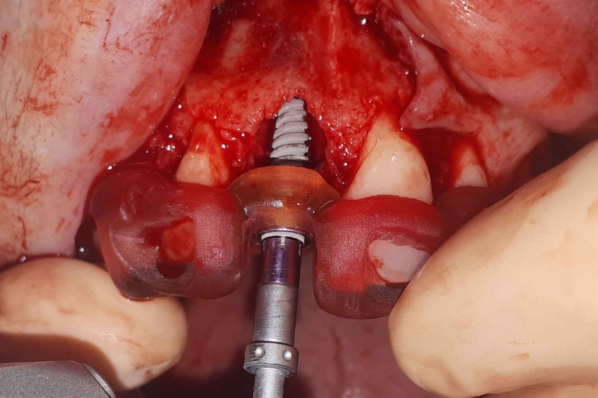 guided surgery quoris 3d