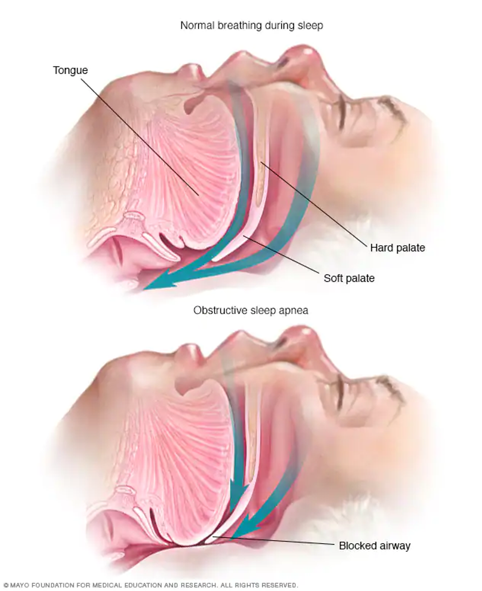 snoring 2