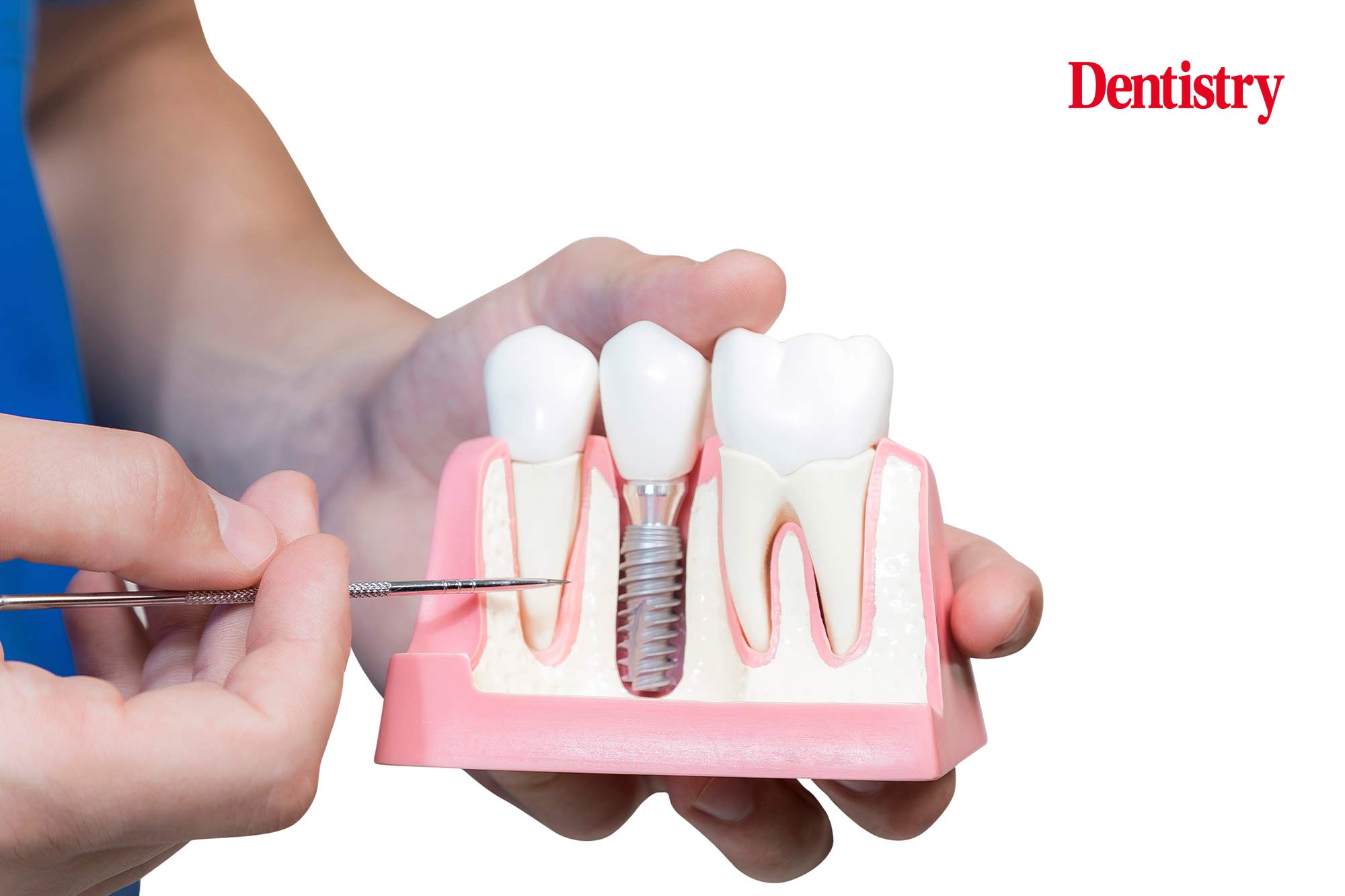 Peri-implantitis