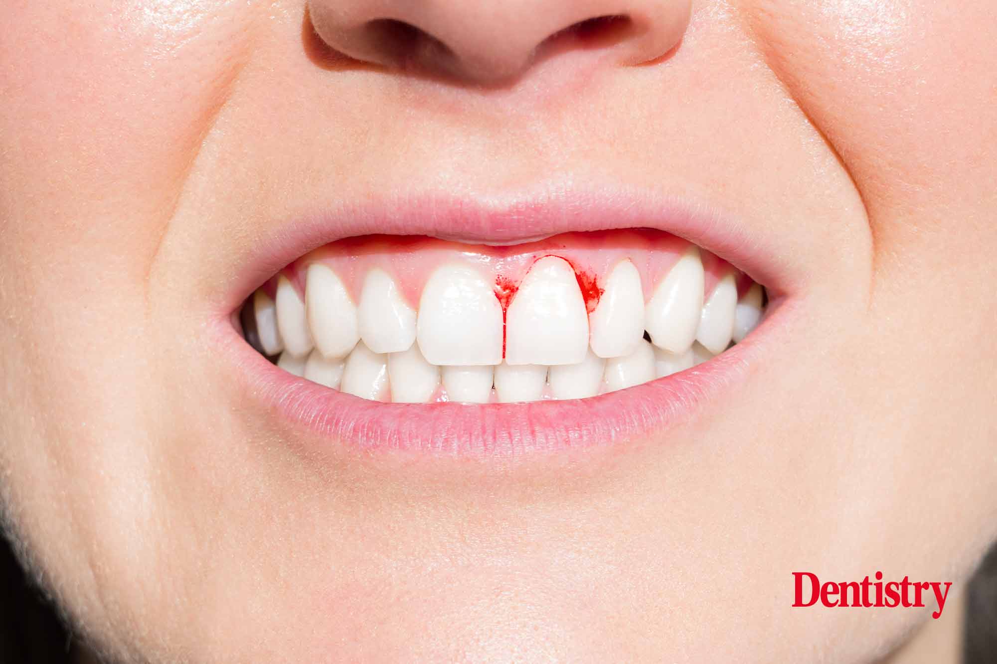 gum inflammation