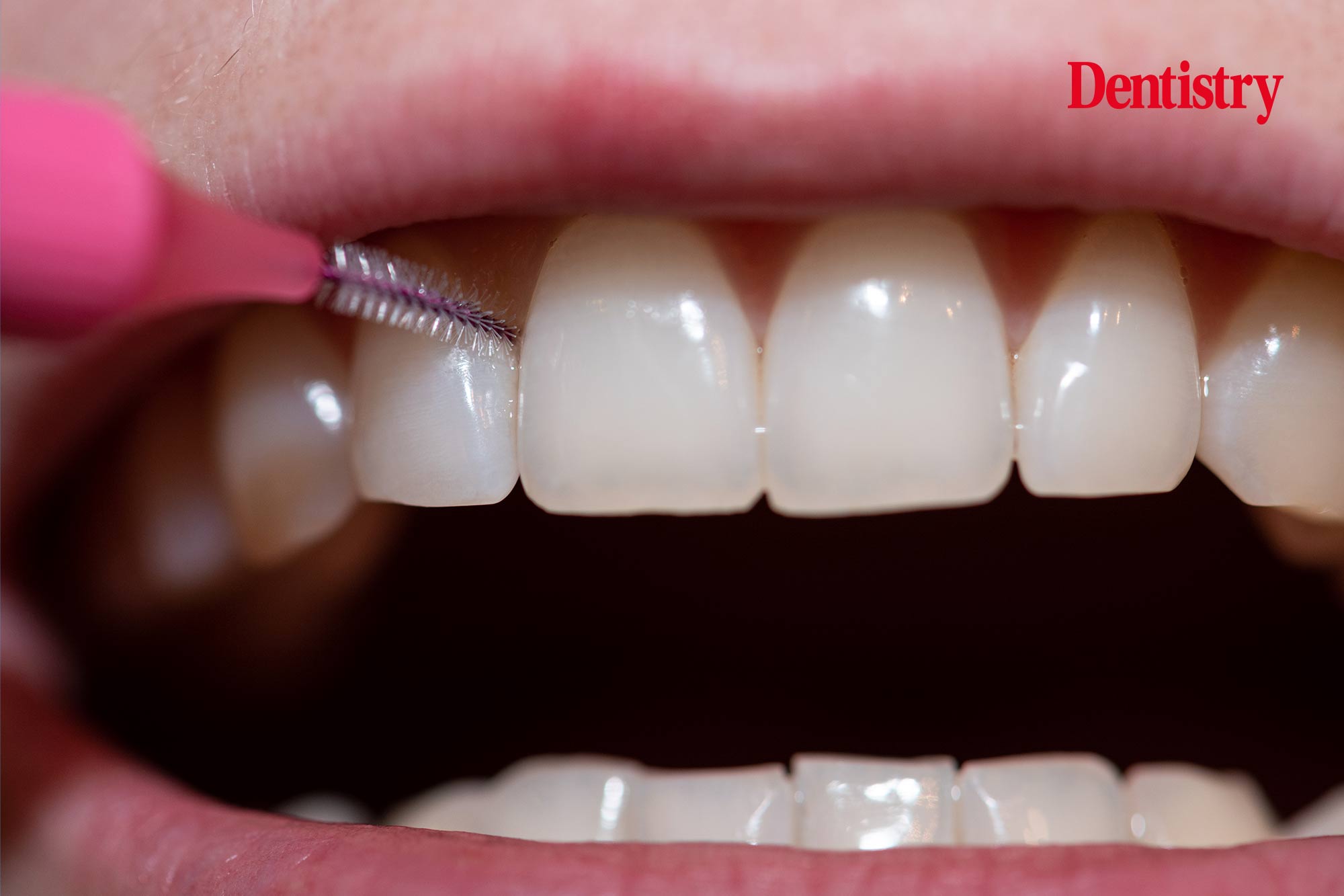 Interdental brushes and rubber interdental picks more efficient in reducing plaque 