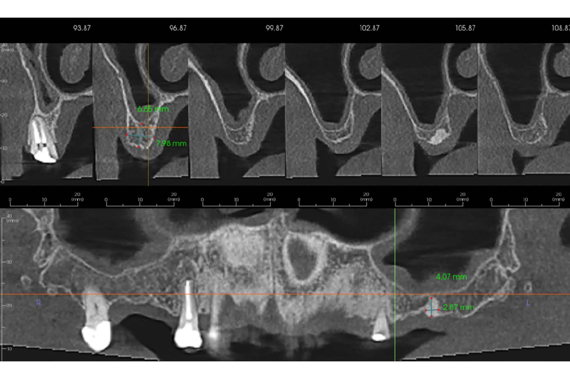 sphenoid sinus