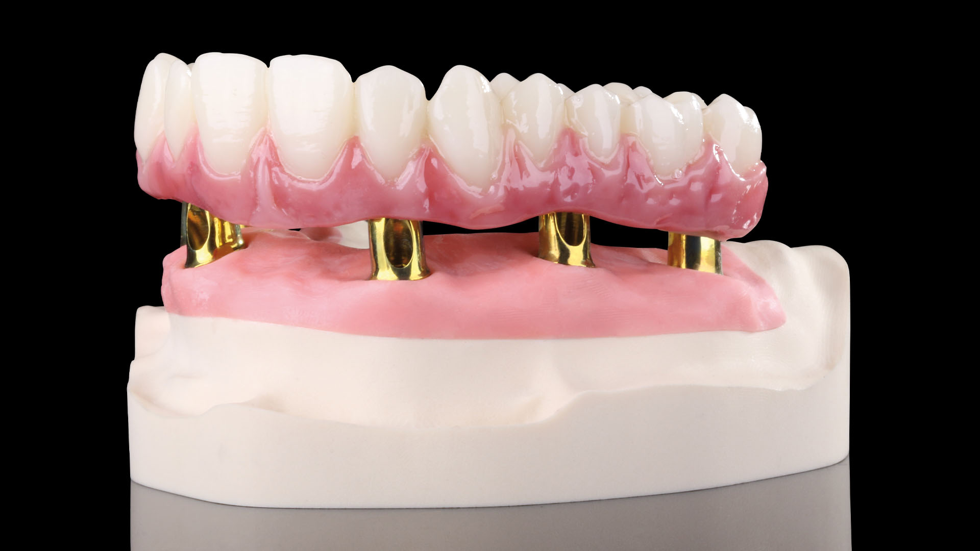 Example of a restoration on individual Raw-Abutments