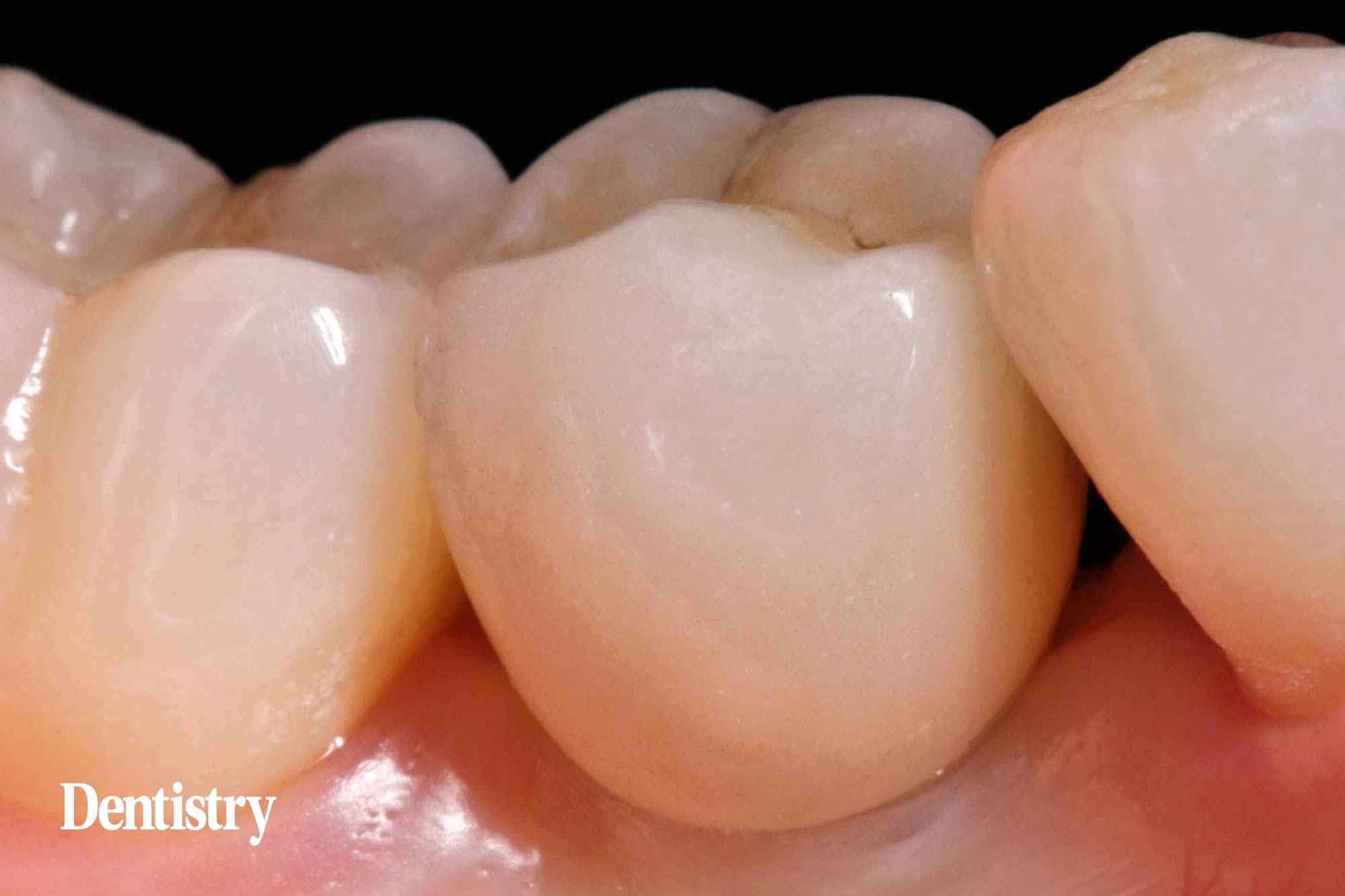 Mauro Fazioni and Andrea Lombardo discuss the importance of making implants with toothlike restoration materials and how you can do this.