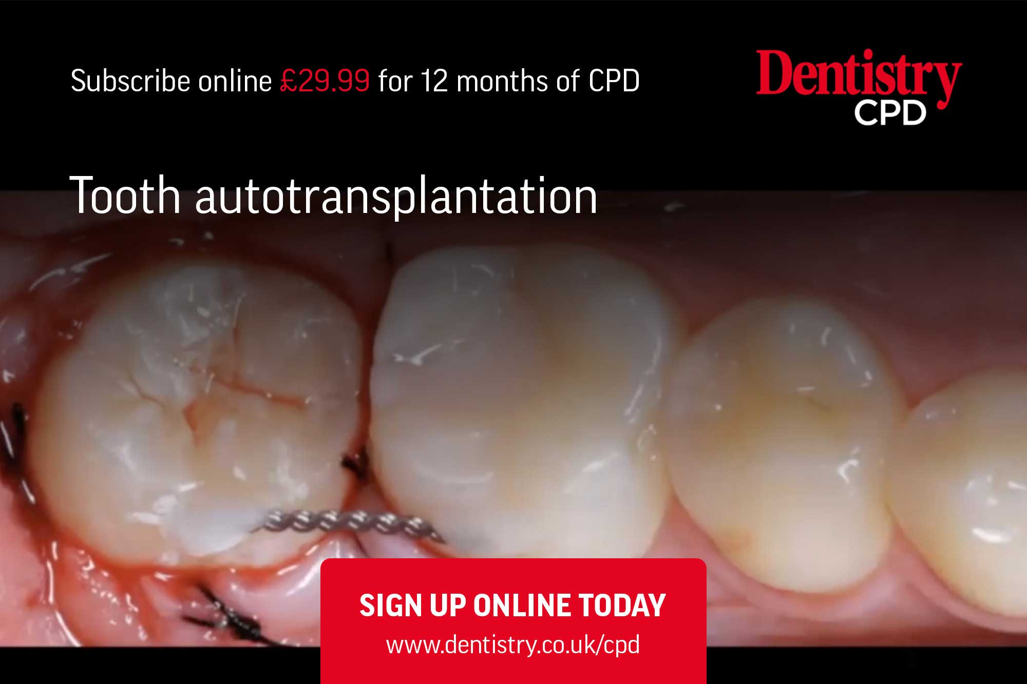 autotransplantation