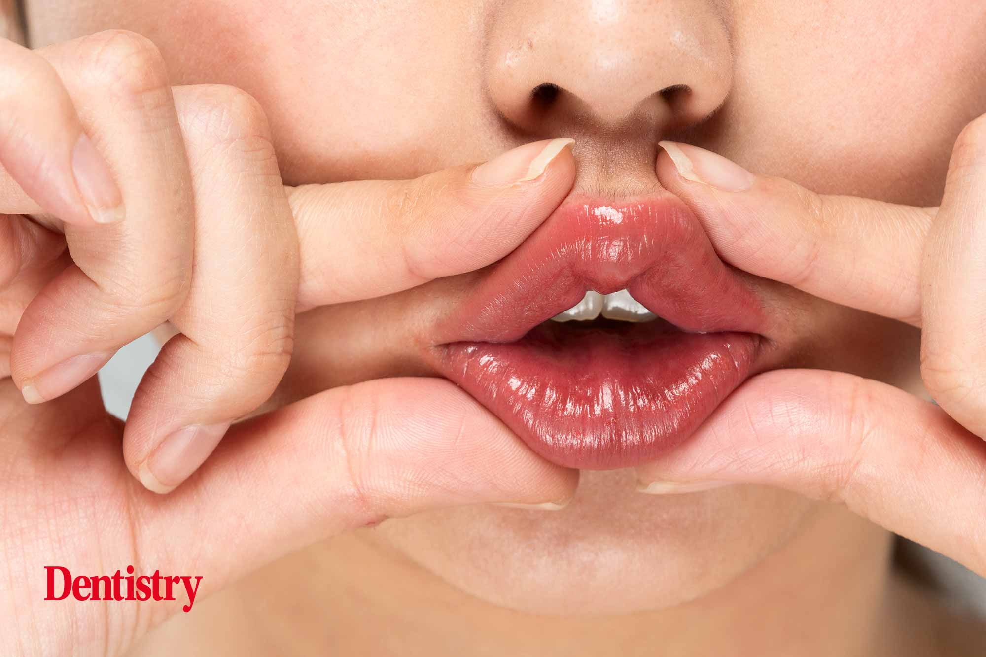 Achieving aesthetic ideals – techniques to avoid the ‘trout pout’ 