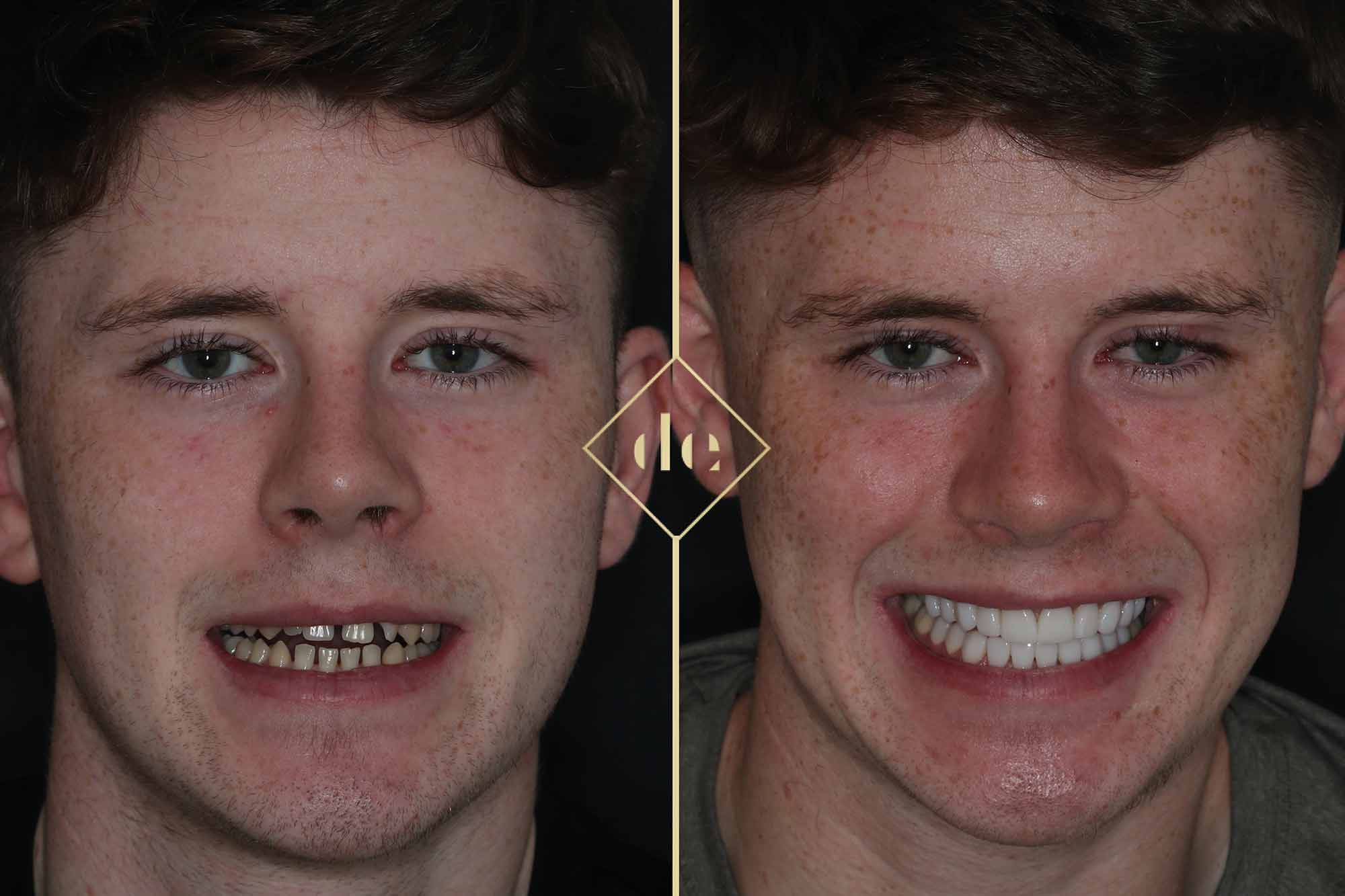 A dual arch composite veneer case using the injection-mould technique