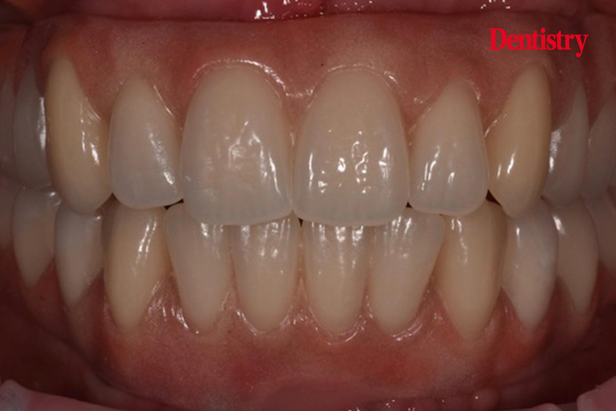 The Sky is the limit – the implant system that lives up to its name