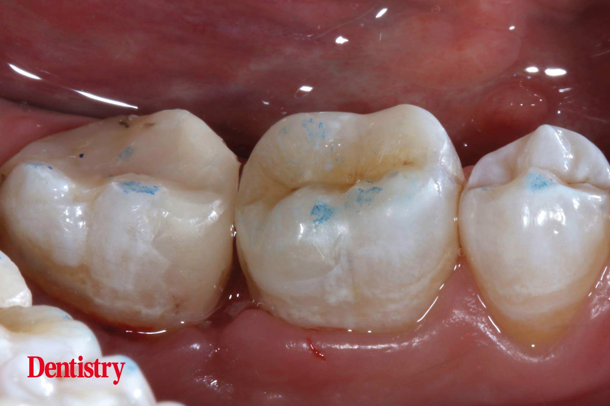 Alan Cantagalli presents an onlay restoration case using natural-looking onlays, digital scanning and CAD design.