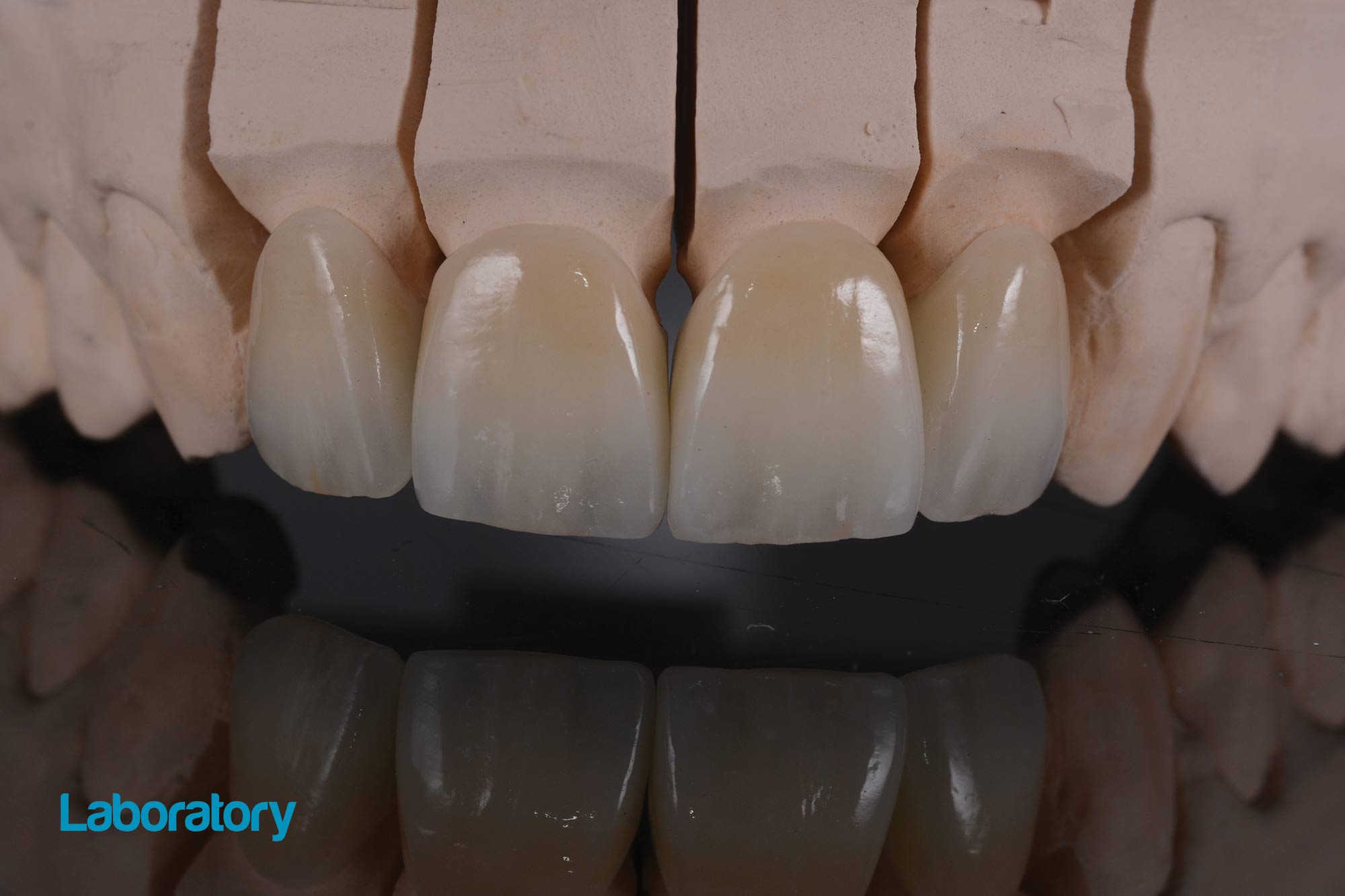 Lorena Dalla Riva presents a smile reconstruction case using incisal edge design with Glam ceramics onto lithium disilicate crown frameworks.