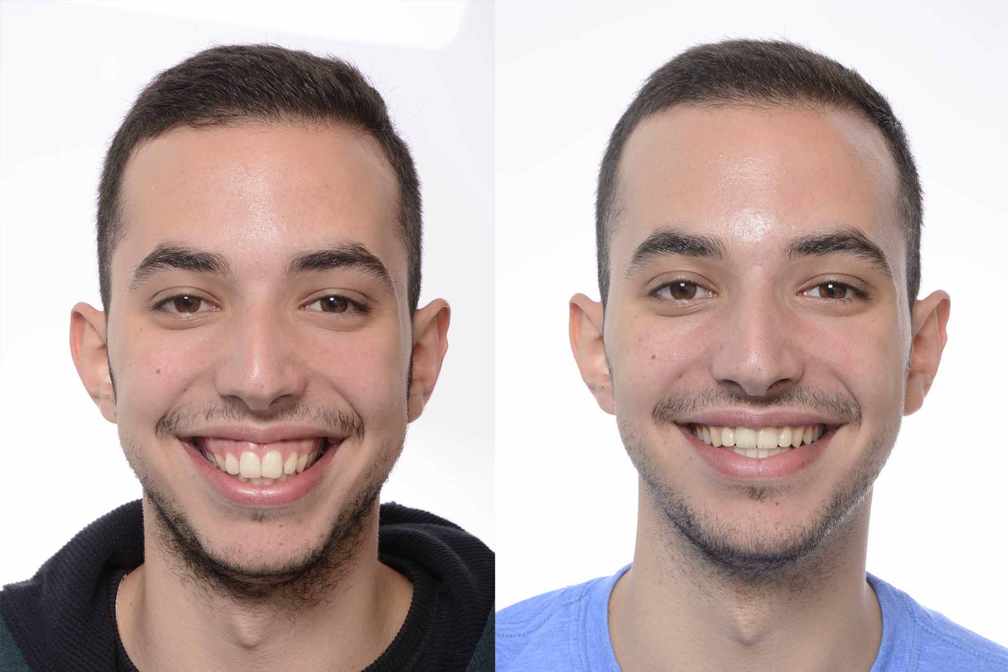 The non-surgical treatment of gummy smiles is a life-changing experience for patients who have been told their only option is major surgery. Register for a hands-on advanced course which explores the controlled and comfortable treatment of gummy smiles.