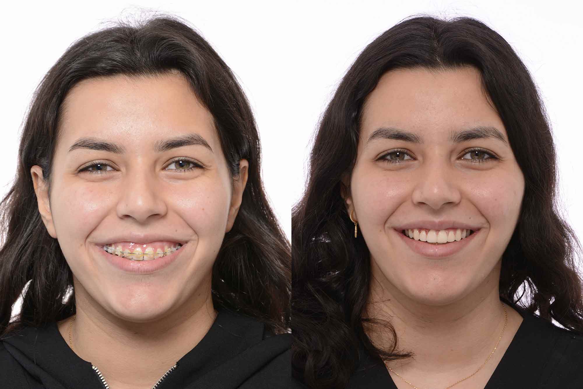 The non-surgical treatment of gummy smiles is a life-changing experience for patients who have been told their only option is major surgery. Register for a hands-on advanced course which explores the controlled and comfortable treatment of gummy smiles.