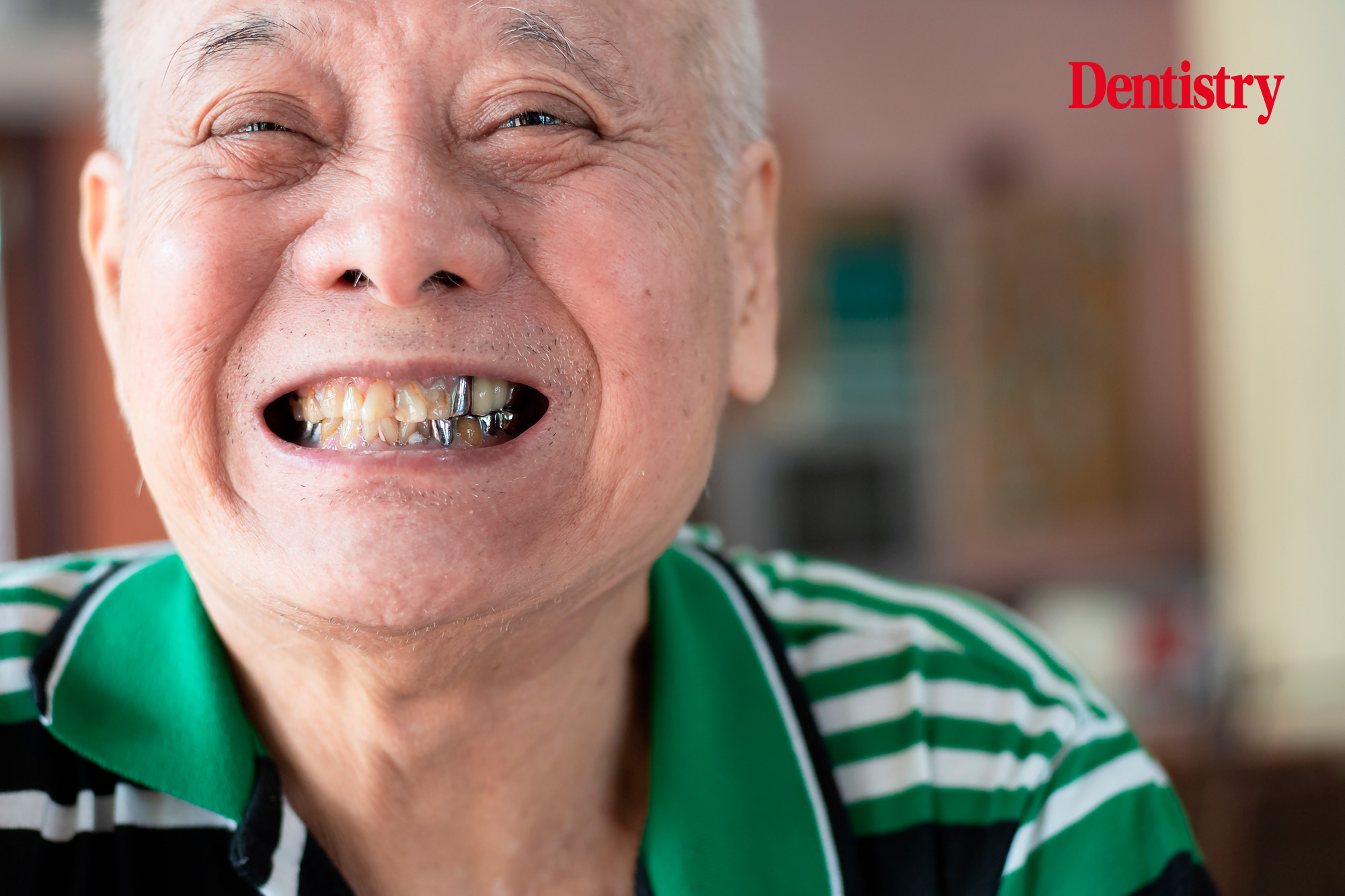 In the 1960s – 1980s, the NHS system actively encouraged dentists to save and restore teeth, thereby creating today’s ‘heavy metal’ generation, explains Kevin Lewis. Yet the NHS is conveniently ignoring its ongoing responsibility to these patients, and abandoning them to an uncertain future.