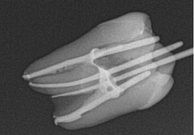 Dr Matthew R Miller presents an introduction to his white paper focusing on the management of complex root canal anatomy, comparing Kerr’s Zenflex file system with two other popular systems.