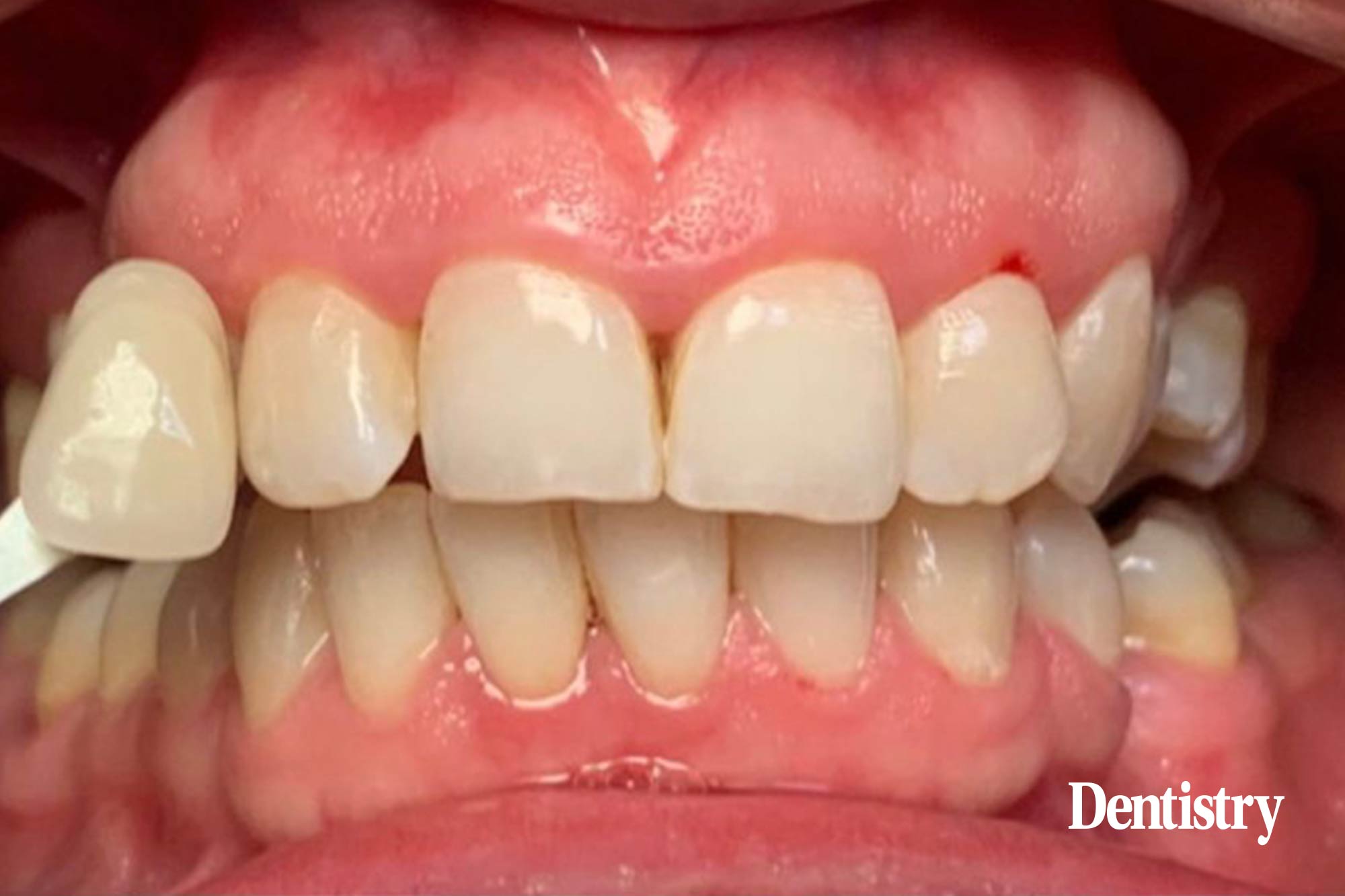 Melica Bastani, an award winning dental hygienist, presents an anxious and periodontally compromised tooth whitening case study for a patient ahead of her wedding. 