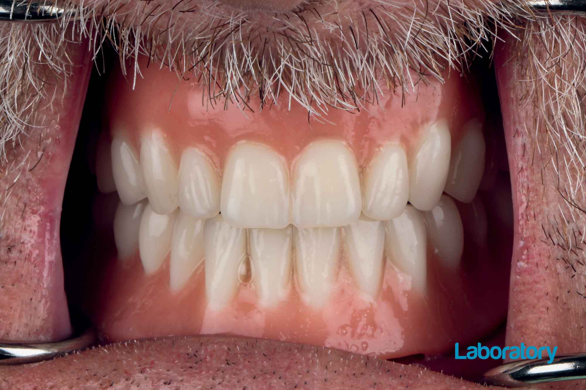 Dr Ingrid Grunert presents an edentulous patient case using complete digital dentures – but is 3D printing accurate enough?