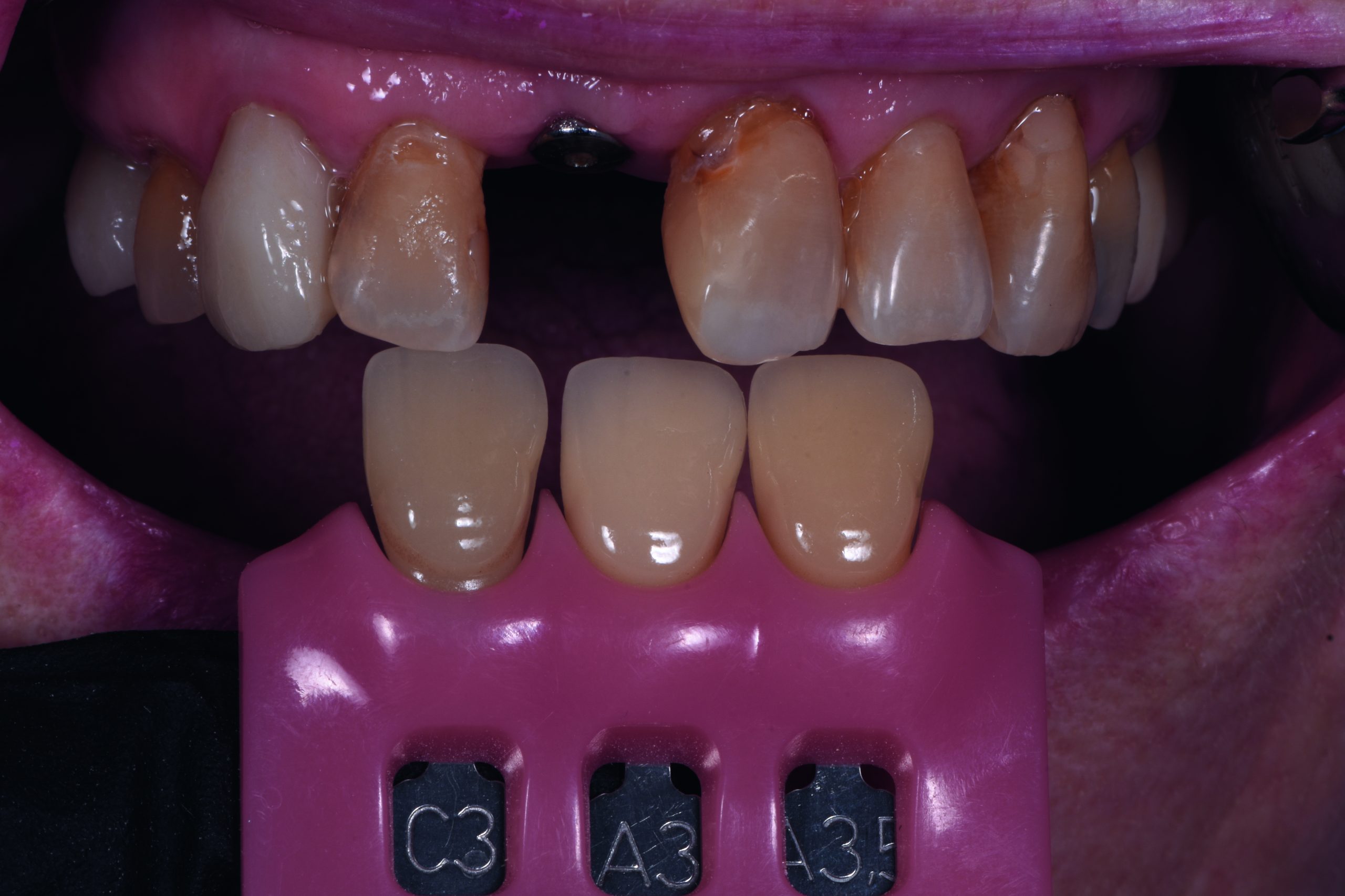 Dimitri Kisel presents a challenging implant restoration case in which a precise shade analysis created a natural-looking, aesthetic result.