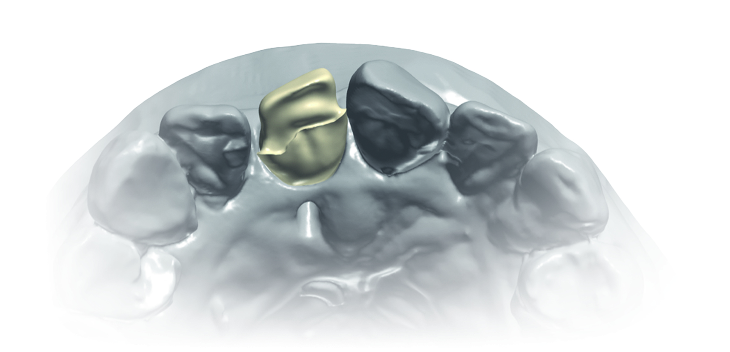 Dimitri Kisel presents a challenging implant restoration case in which a precise shade analysis created a natural-looking, aesthetic result.