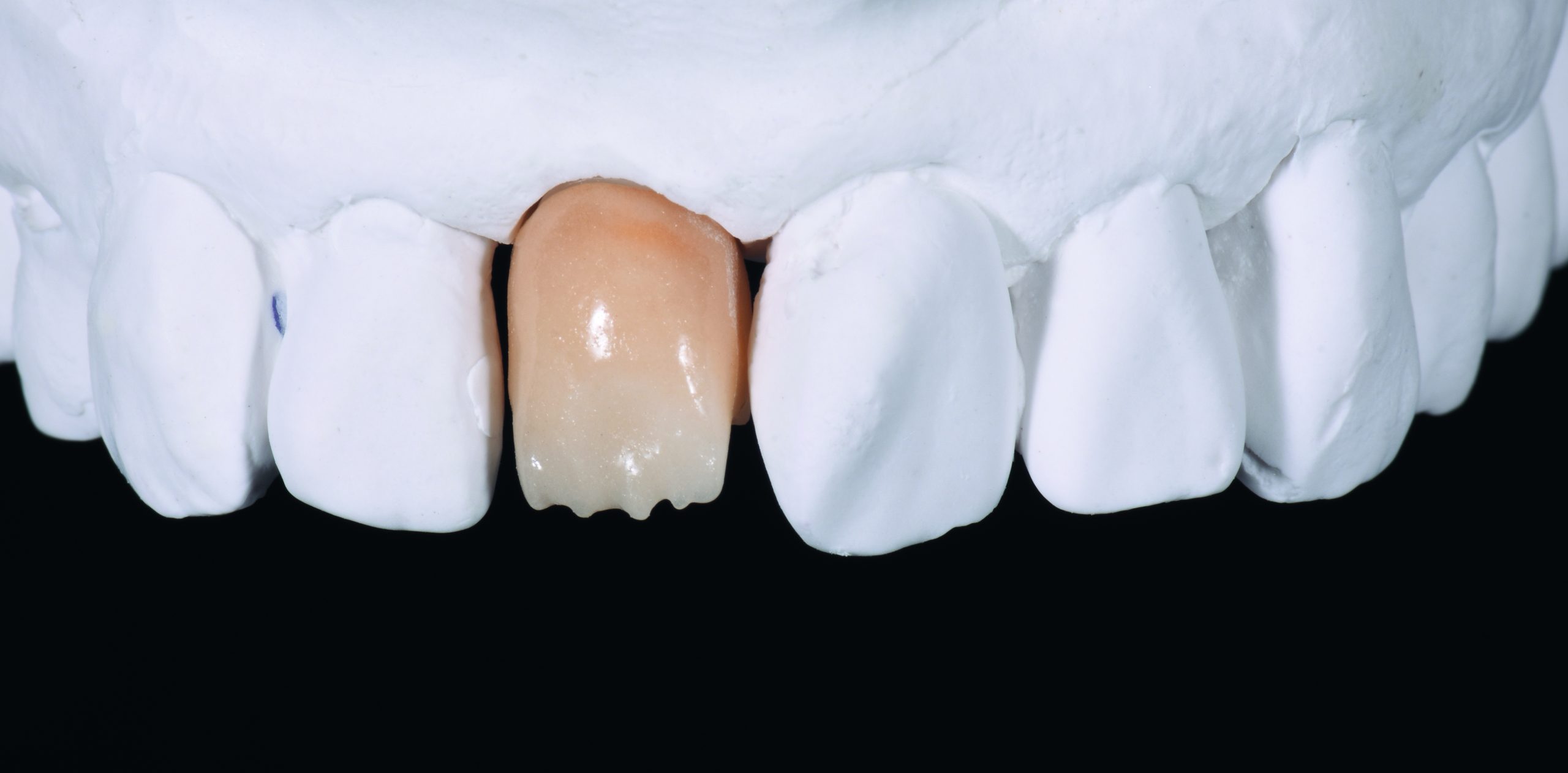 Dimitri Kisel presents a challenging implant restoration case in which a precise shade analysis created a natural-looking, aesthetic result.