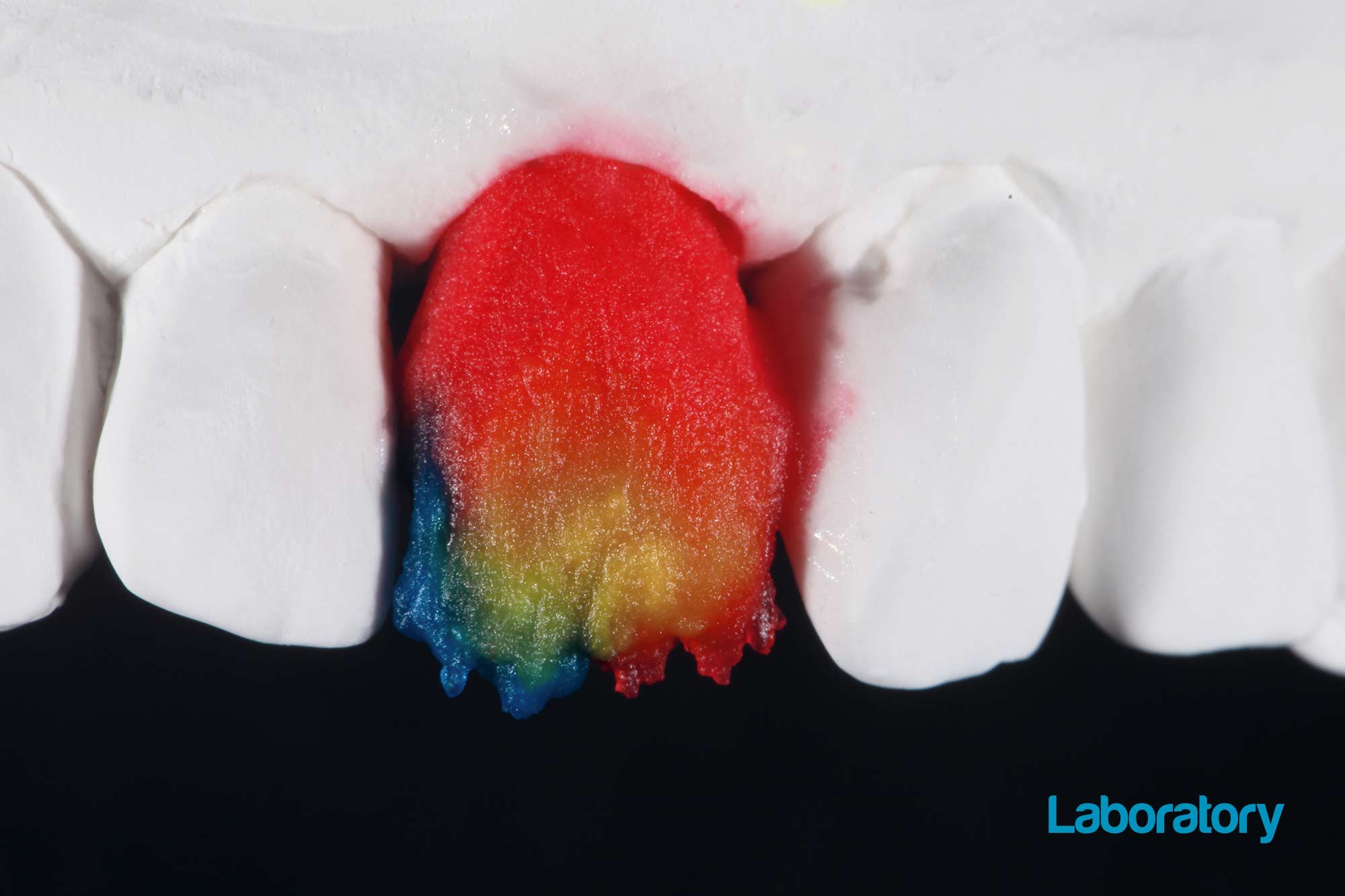 Dimitri Kisel presents a challenging implant restoration case in which a precise shade analysis created a natural-looking, aesthetic result. 