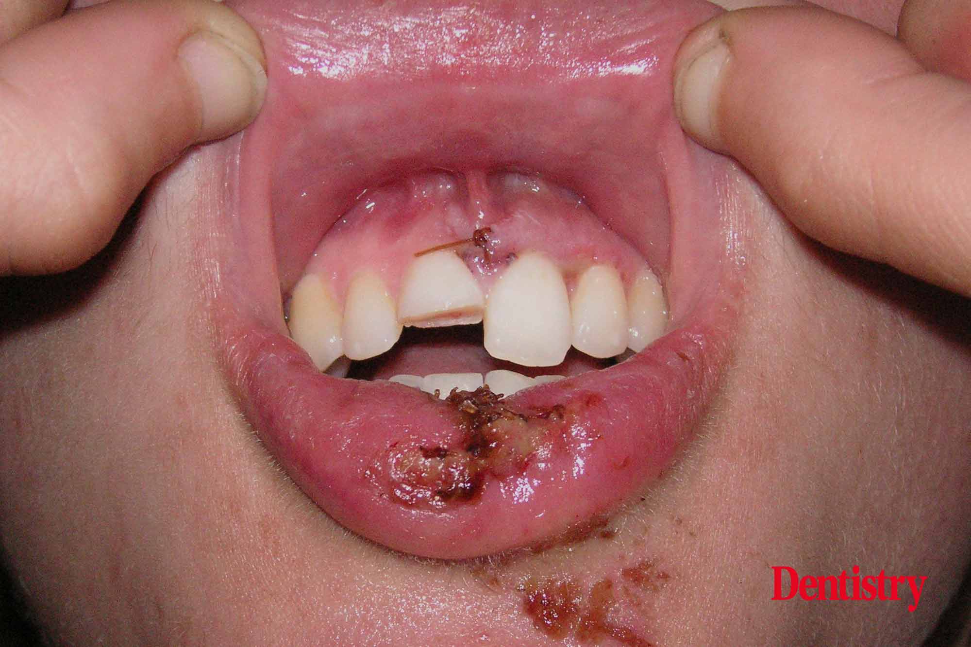 Juergen Manhart and Hubert Schenk present a full ceramic crown case after a complicated fracture of an anterior tooth.