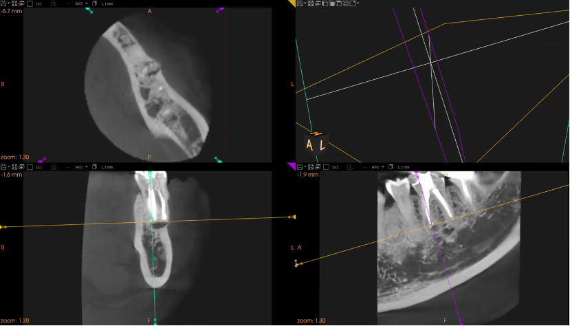 Dr Sanj Bhanderi discusses minimally invasive endodontics, the microsurgery approach and the fundamental concept of modern endodontics.