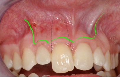 Dr Sanj Bhanderi discusses minimally invasive endodontics, the microsurgery approach and the fundamental concept of modern endodontics.