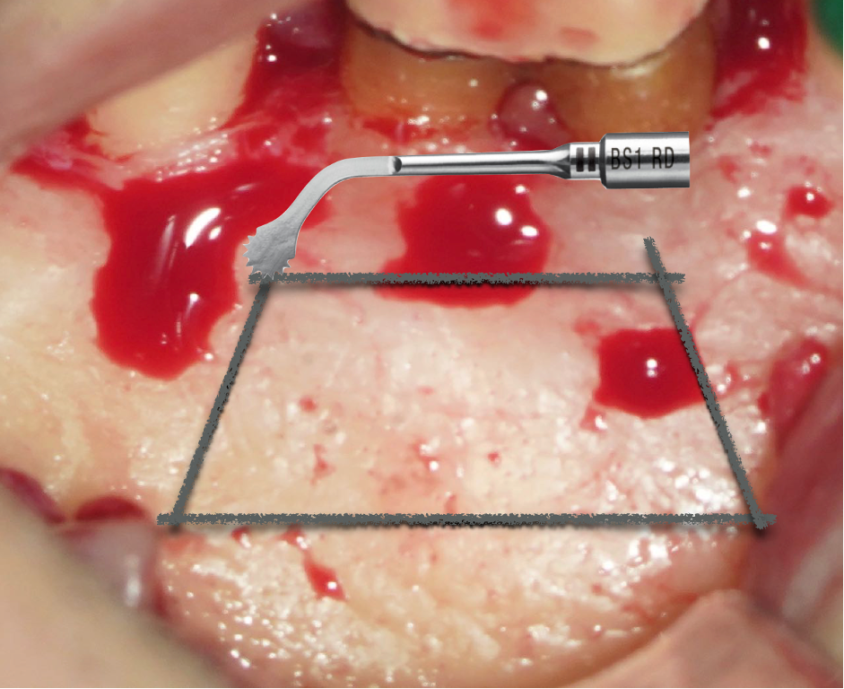 Dr Sanj Bhanderi discusses minimally invasive endodontics, the microsurgery approach and the fundamental concept of modern endodontics.