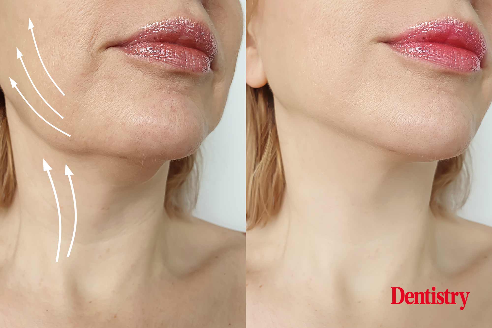To combat the signs of ageing, Dr Anne Gormley shows how you can combine the specialties of cosmetic dentistry with facial aesthetics.