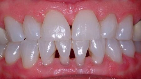 Richard Jones, a specialist orthodontist at Total Orthodontics, part of Bupa Dental Care, discusses ‘Black Triangles’ and how to reduce the risk of them.