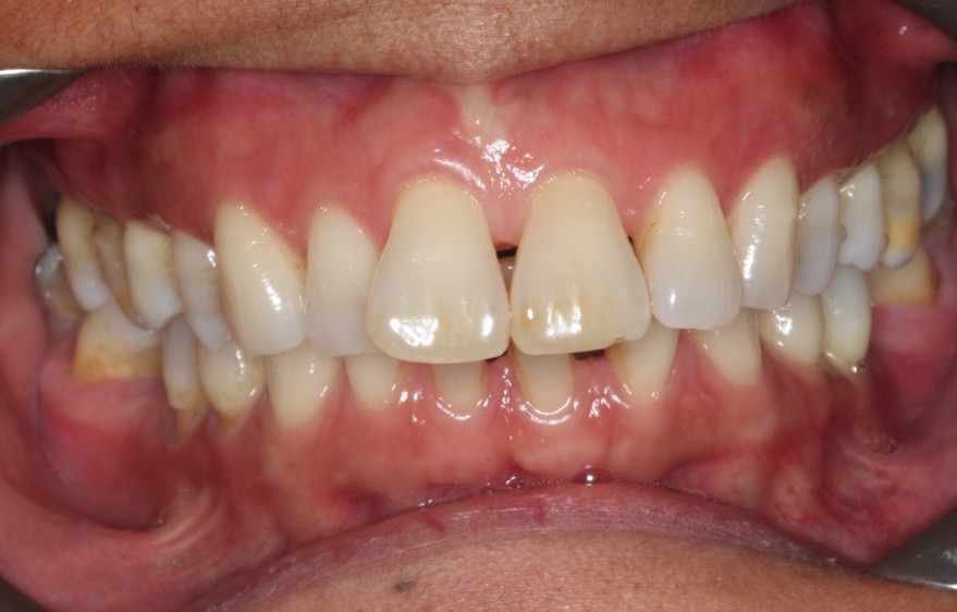 Richard Jones, a specialist orthodontist at Total Orthodontics, part of Bupa Dental Care, discusses ‘Black Triangles’ and how to reduce the risk of them.