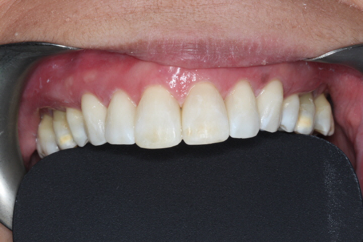 Richard Jones, a specialist orthodontist at Total Orthodontics, part of Bupa Dental Care, discusses ‘Black Triangles’ and how to reduce the risk of them.