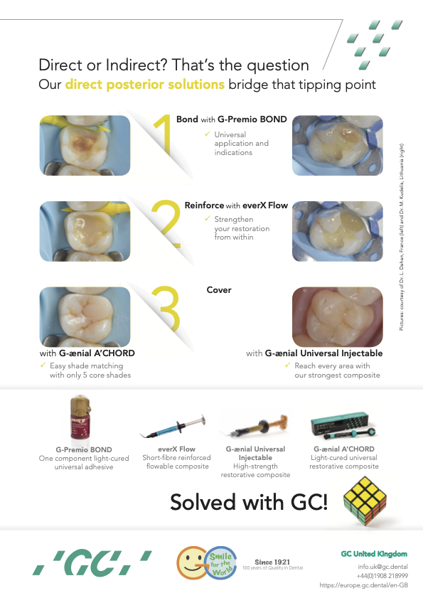 GC's workflow for posterior direct restorations