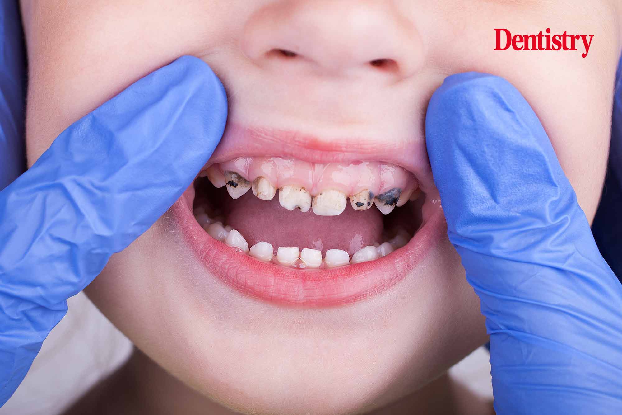 Almost 80% in healthcare report higher tooth decay among children