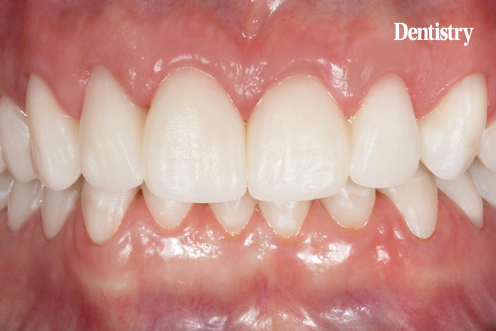 A safeguarded approach for a complete restoration 
