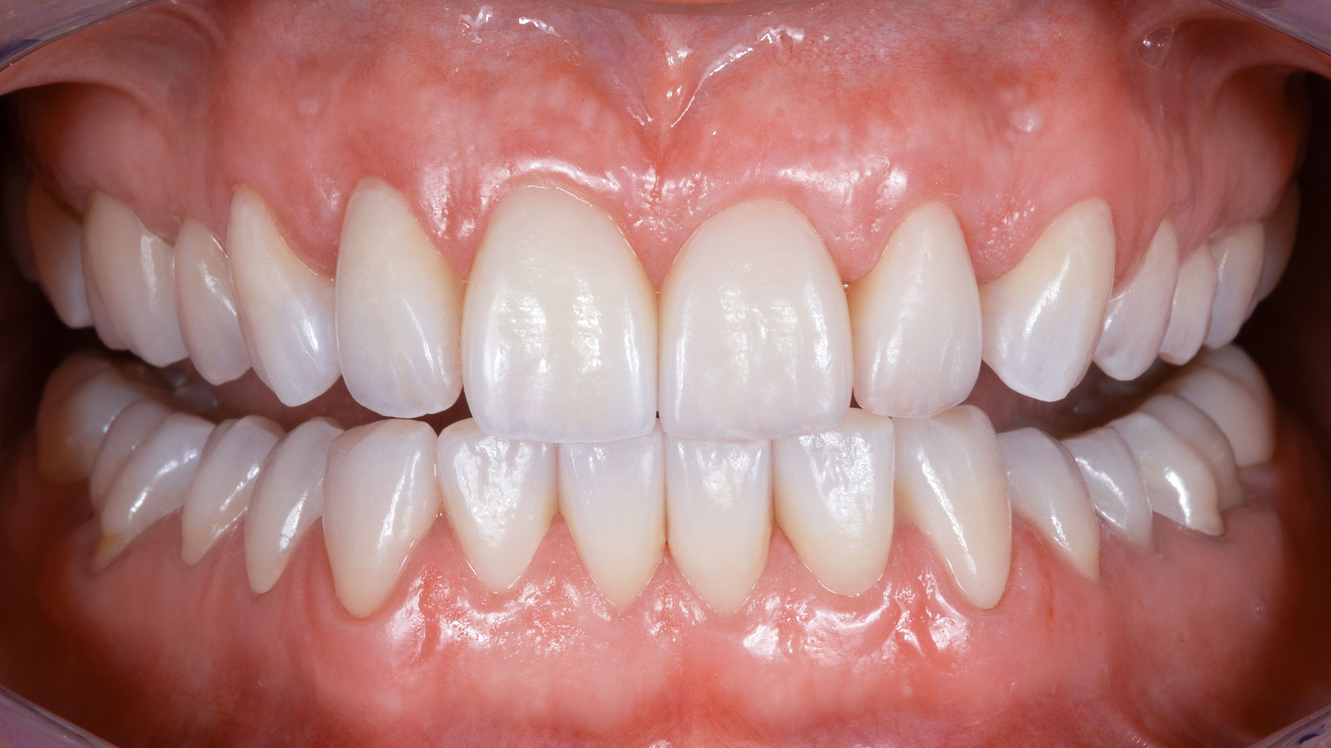 zirconia crowns